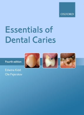 Essentials of Dental Caries.jpg